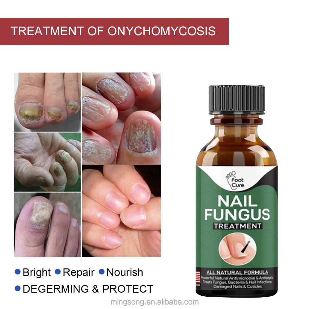 Famedeals.pk™ - Nail Fungi Treatment Serum