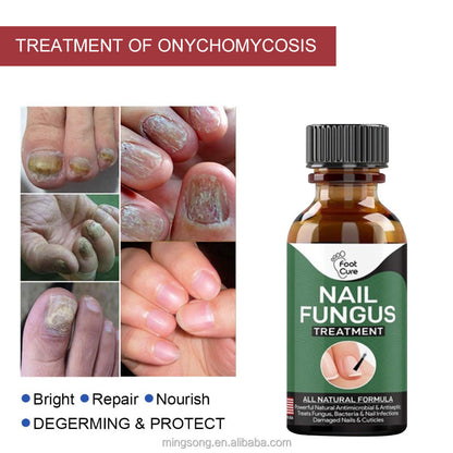 Famedeals.pk™ - Nail Fungi Treatment Serum